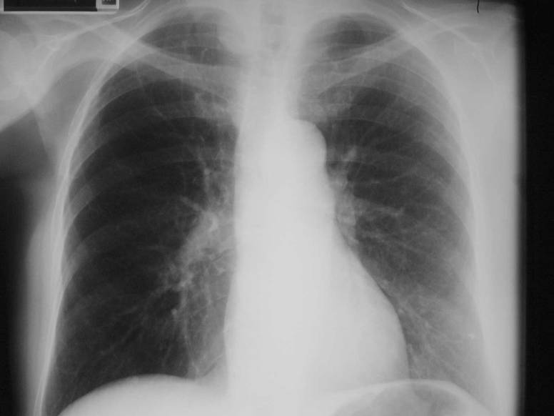 Basic Chest X Ray Interpretation